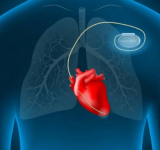 Lanzan campaña en Cochabamba para colocar 60 marcapasos gratuitos a pacientes